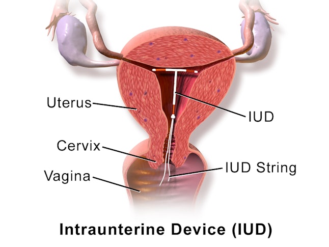 How Do Iuds Work What You Need To Know About The Popular Form Of Birth Control